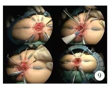 手术演示肠造口术后单切口腹腔镜辅助巨结肠根治术（Duhame1术）