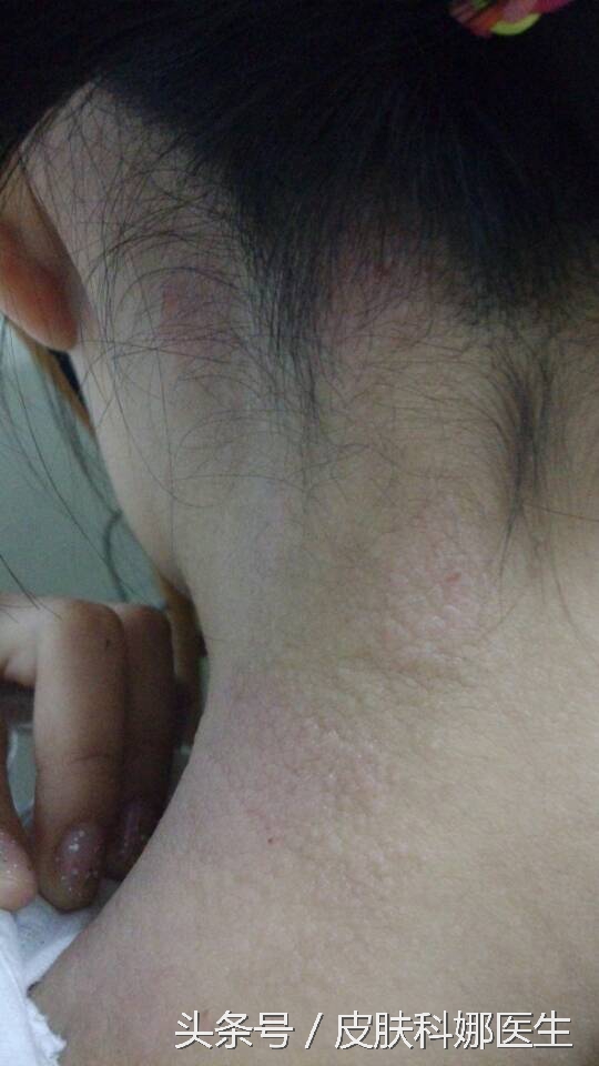 上眼皮神经性皮炎痒怎么办,两个眼皮痒是神经性皮炎吗