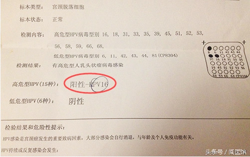 hpv检测52和81是阳性严重吗,hpv检测出了宫颈癌