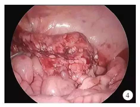 手术演示肠造口术后单切口腹腔镜辅助巨结肠根治术（Duhame1术）