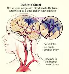 脑出血患者如何预防并发症,护理脑出血病人的方法和技巧