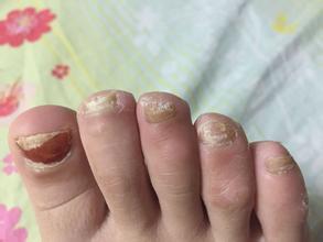 得了灰指甲最简单有效解决办法,为什么灰指甲容易长在脚上