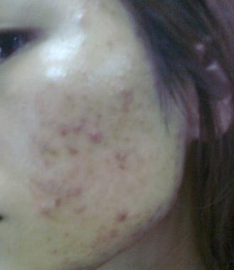 痘印怎么快速消除,痘痘怎么快速消除不留痘坑