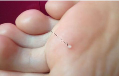 鸡眼跖疣胼胝如何区别,跖疣鸡眼和胼胝看什么科