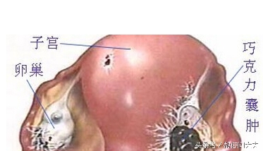 痛经严重一定是巧克力囊肿吗,巧克力囊肿的病因及治疗