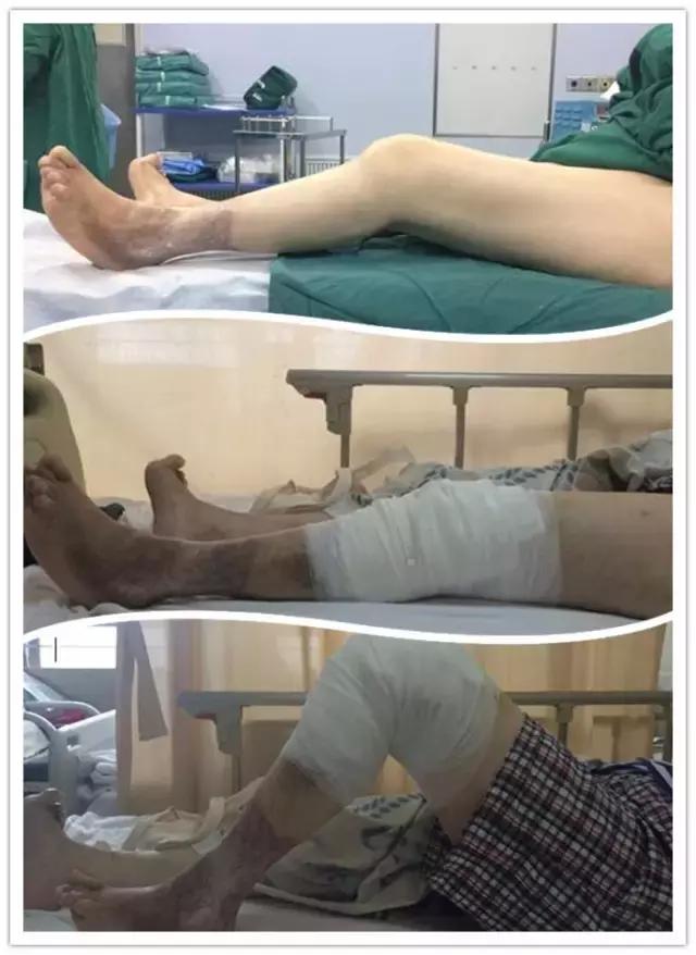 3d打印膝关节置换术效果好吗,膝关节置换3d打印图片