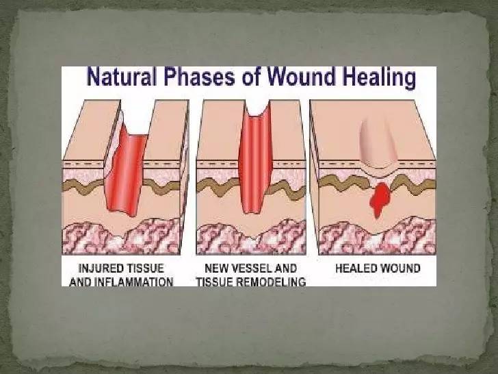 术后恢复多久能洗澡,双眼皮术后多久能洗澡