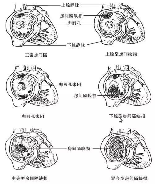 无顶冠型房间隔缺损超声诊断,超声室间隔缺损分型