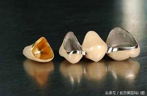 到底应不应该做烤瓷牙,来自医生的忠告不要随便做烤瓷牙