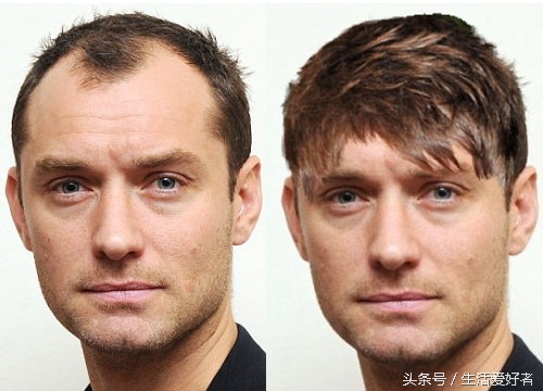 男性脂溢性脱发生发洗发水,男性脱发育发最好效果排行榜