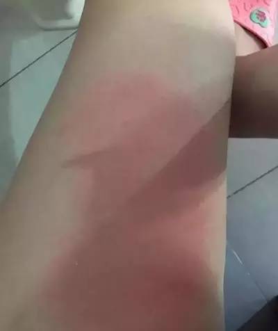 母乳冰敷！美女医生做“直播”引来一群网友围观：长知识了！