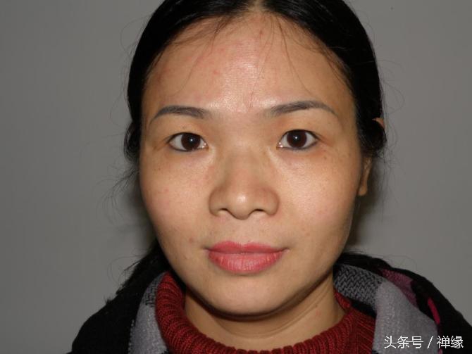 产后皮肤暗黄需要怎么护肤,产后皮肤暗黄还长痘怎么办