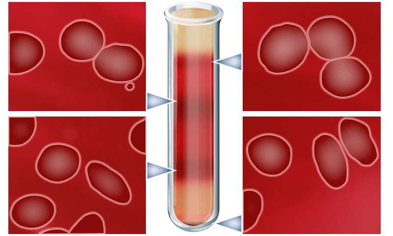 镰刀形红细胞贫血症,治疗镰刀型细胞贫血症的方法