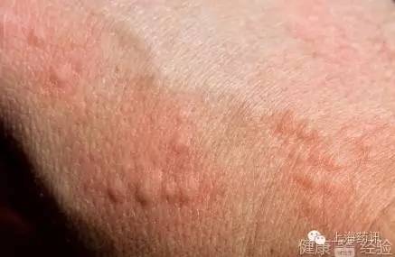 以前使用头孢、青霉素类药物过敏了，现在还能用吗？