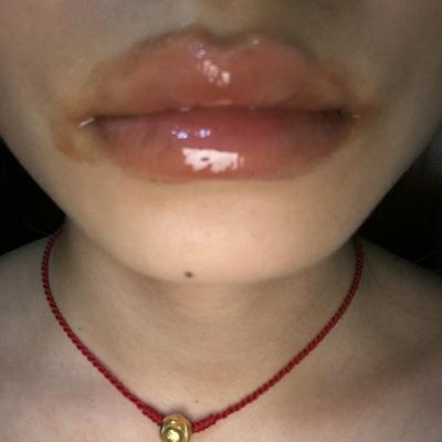 为什么剥脱性唇炎那么难好,剥脱性唇炎是细菌还是病毒