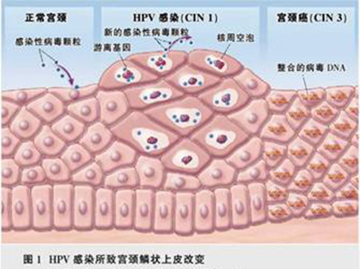hpv哪几个型号最可怕,hiv和hpv哪个更可怕