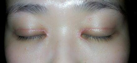 全切双眼皮疤痕增生期的表现,双眼皮手术后疤痕增生抹什么药