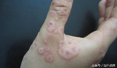 春季眼睛过敏发痒怎么办,春季皮肤过敏是什么原因