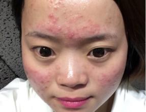 额头全是小米粒的痘痘怎么去掉,额头上有很多痘痘怎么办