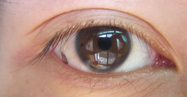 孙红雷谈黑痣长在哪里,孙红雷演的黑痣病变