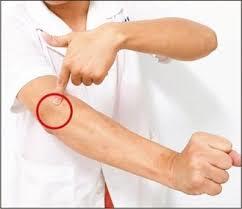 网球肘和妈妈肘,妈妈得了网球肘怎么治