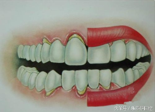 牙缝里卡了小小的鱼刺怎么拔出来,牙缝深处的菜叶怎么弄出来