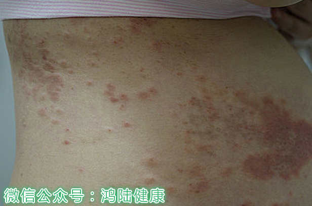 孕期湿疹怎么缓解,孕期湿疹可以擦妊娠油吗