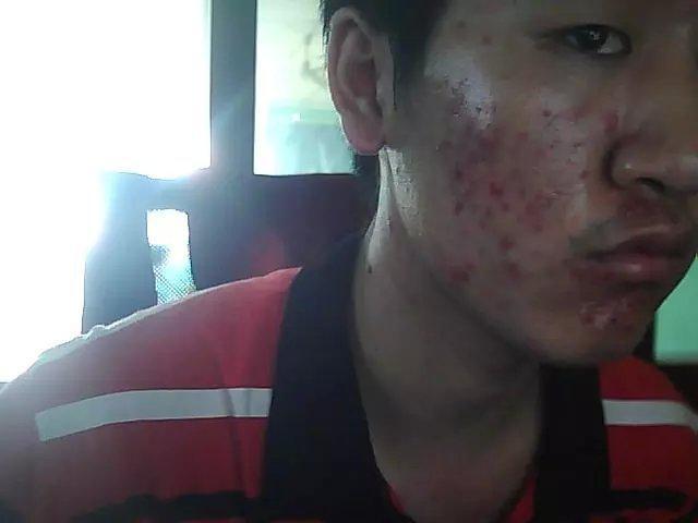 常年长痘的皮肤怎么调理回来,经常长痘如何快速消除