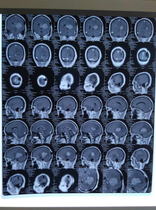 脑胶质瘤复发怎么处理,脑胶质瘤复发怎么治疗