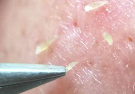 去黑头小技巧外国人,去黑头不需要任何工具的方法