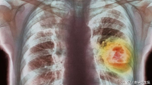 中医药治肺癌特效药,sbrt治疗早期肺癌疗效如何