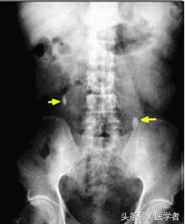 输尿管上段结石用哪种手术最好,输尿管狭小引起结石的治疗方法