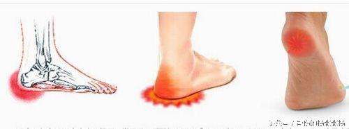 糖尿病人足跟痛是什么原因,足跟痛找到原因最关键
