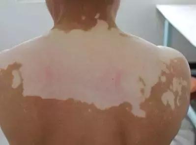 白癜风太难治？辨证施治很重要