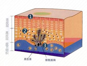 妊娠斑是怎么引起的去脸上妊娠斑的小偏方