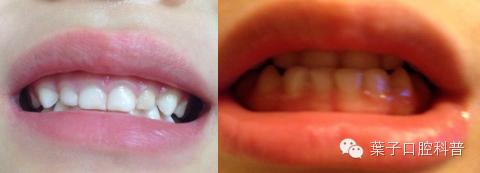 孩子鼻炎影响学习吗,小孩学习偏科跟鼻炎有关吗