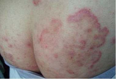 身上股癣,身上起股癣怎么治