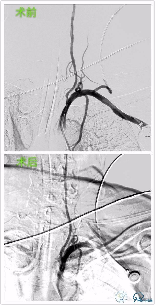 脑血管介入培训基地,脑卒中血管介入治疗