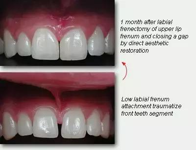 前牙有缝有什么说法吗,前牙有洞怎么补救