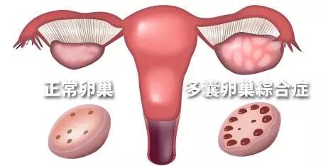 孕期卵巢问题不可轻视
