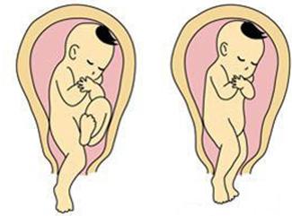 臀位宝宝成功顺产,固执的妈妈断送了孩子的生命