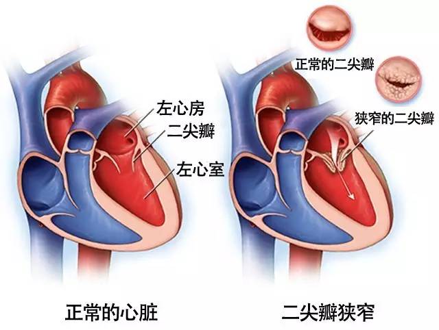干货丨“心脏阀门”二尖瓣出故障了怎么办？