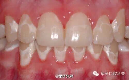 蛀牙怎样才能控制住不再有蛀牙,蛀牙怎么避免更严重