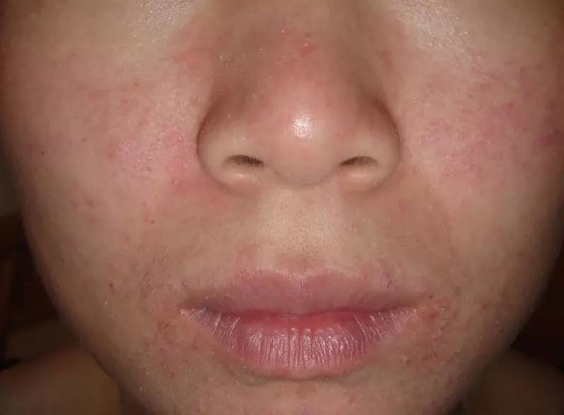 得了脂溢性皮炎会不会秃,得了脂溢性皮炎一定会秃顶吗