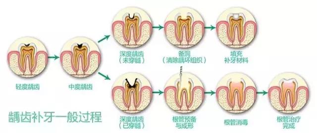 蛀牙怎样才能控制住不再有蛀牙,蛀牙怎么避免更严重
