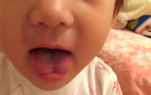 宝宝w型舌需要处理吗,宝宝w型舌头体质怎么样