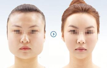 下颌角决定自己的颜值,下颌线决定颜值