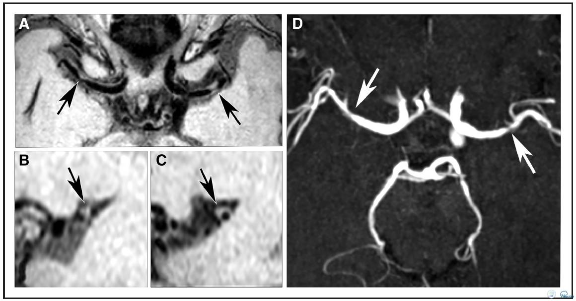 动脉粥样硬化疾病的影像诊断,脑动脉粥样硬化大脑的形态学变化