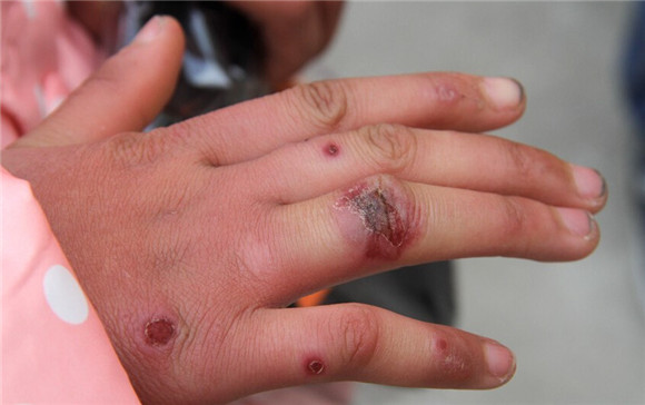 冻疮怎么办最有效的方法,冻疮的快速消除方法家用