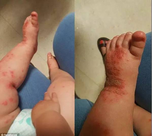 传疯了！只因家人一个习惯性的动作，1岁宝宝从头到脚染满病毒！